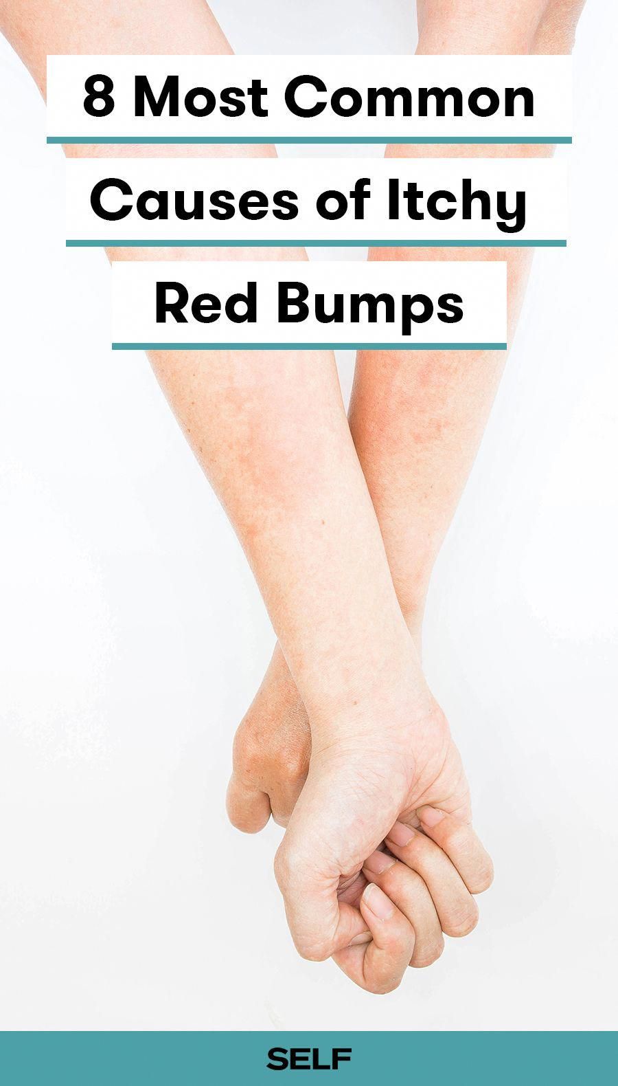 10 Common Causes of Itchy, Red Bumps and Skin Rashes ...