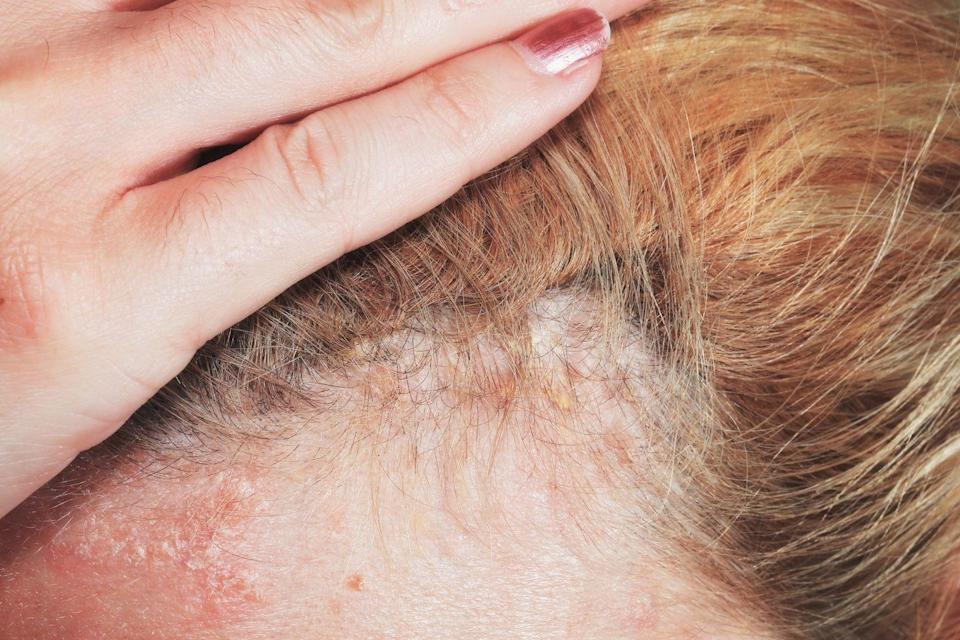 10 Itchy Scalp Causes That Having Nothing to Do With Your Shampoo