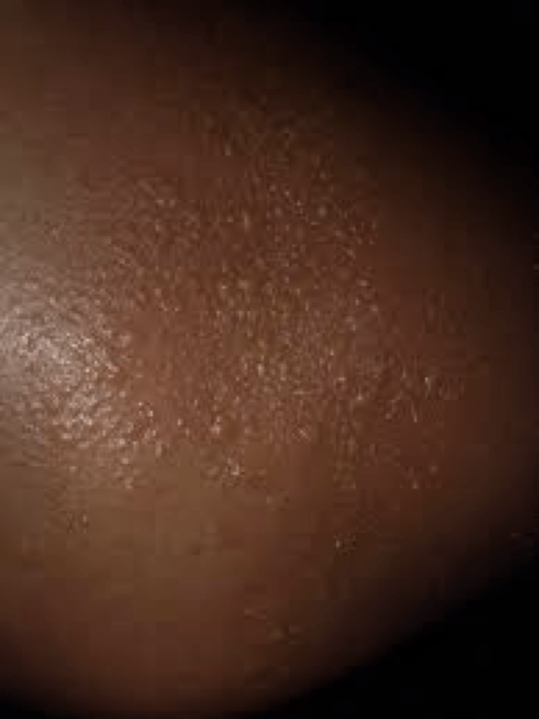 10 Most Common Skin Rashes On Black Skin