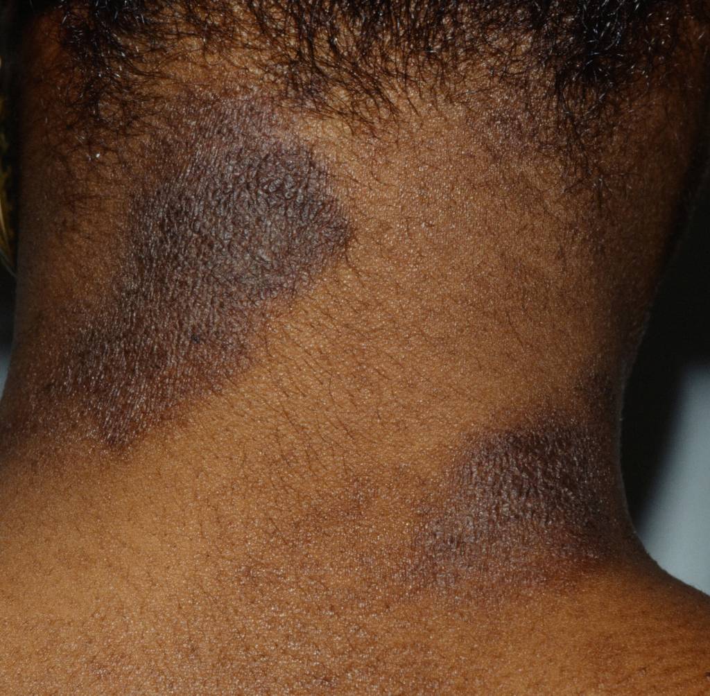 10 Most Common Skin Rashes On Black Skin