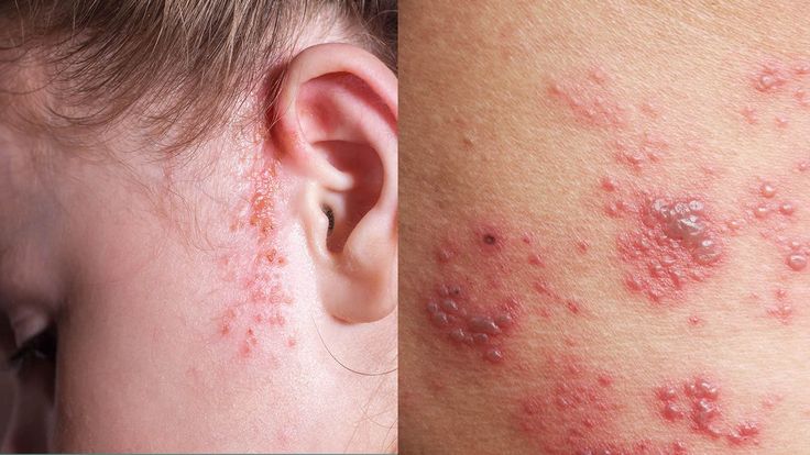 10 Rashes That Could Reveal a Dermatologic Disease » in ...