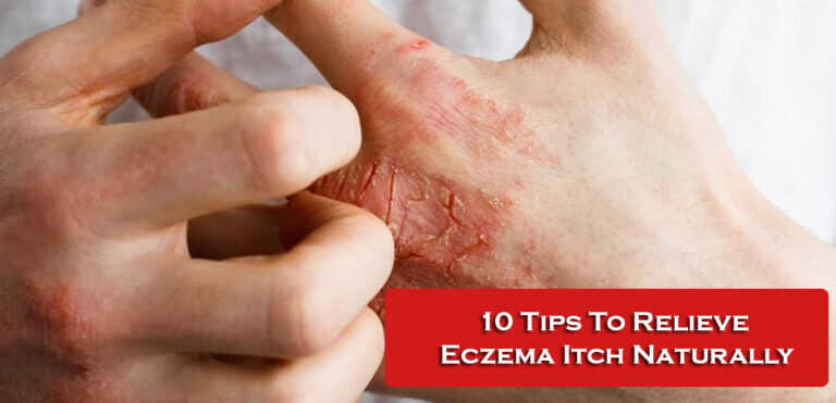 10 Tips To Relieve Eczema Itch Naturally