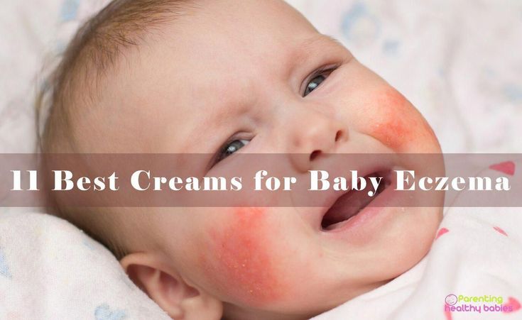 11 Signs And Symptoms That A Baby Is Allergic To Formula # ...