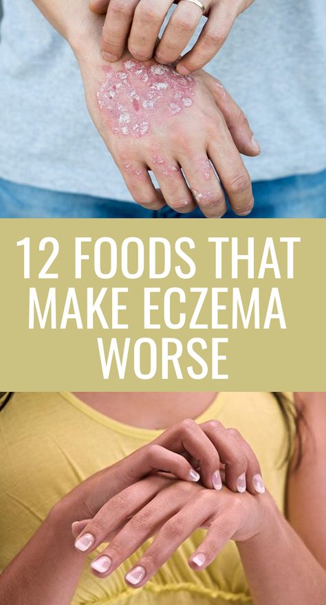 12 Foods that Make Eczema Worse