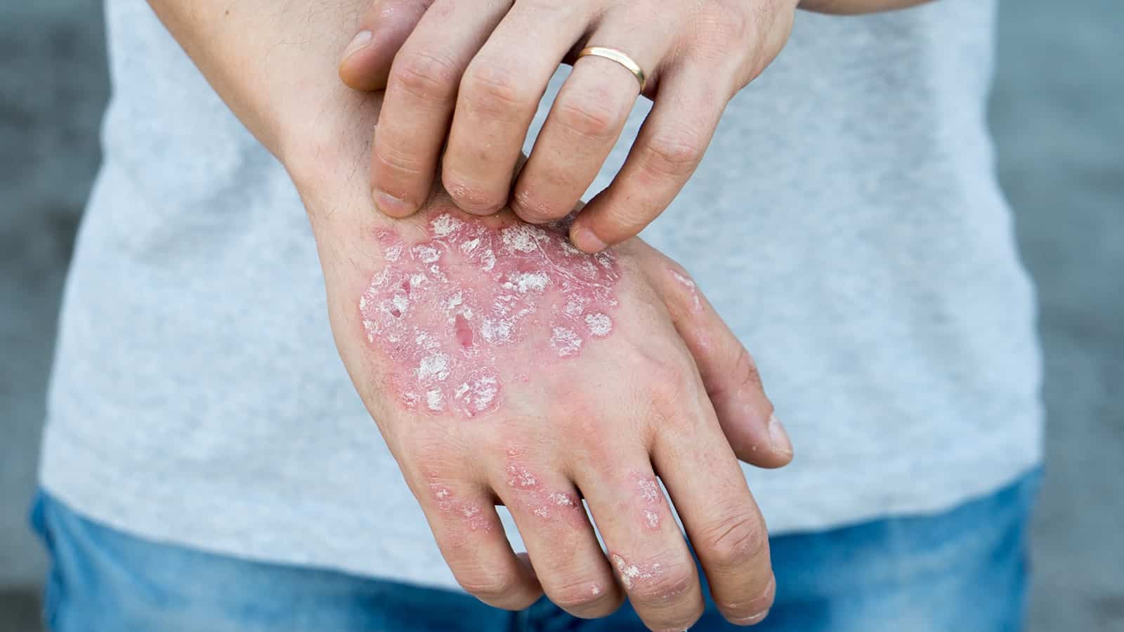 12 Foods that Make Eczema Worse