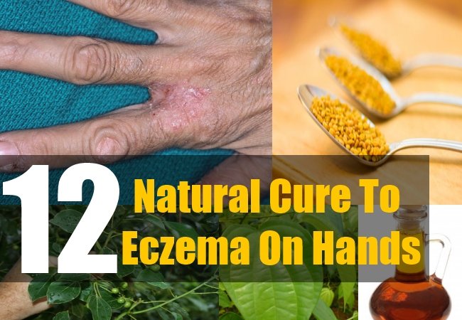 12 Natural Cure For Eczema On Hands