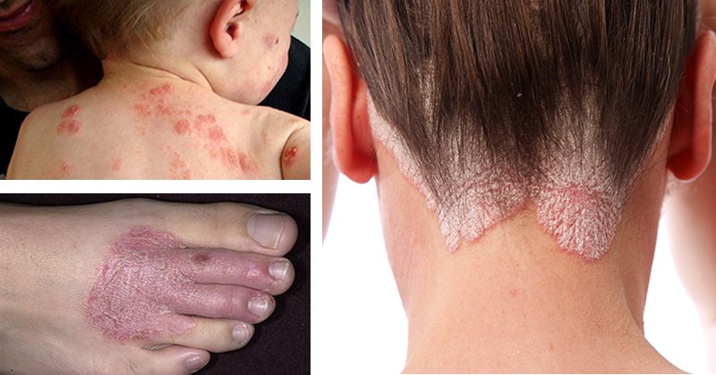 12 Natural Remedies For Eczema, Rashes and a Range of ...