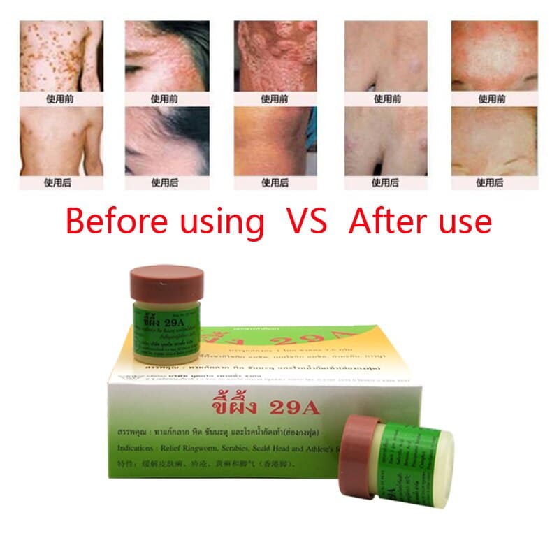 12PCS Thailand 29A Natural Ointment Psoriasi Eczma Cream Works Really ...