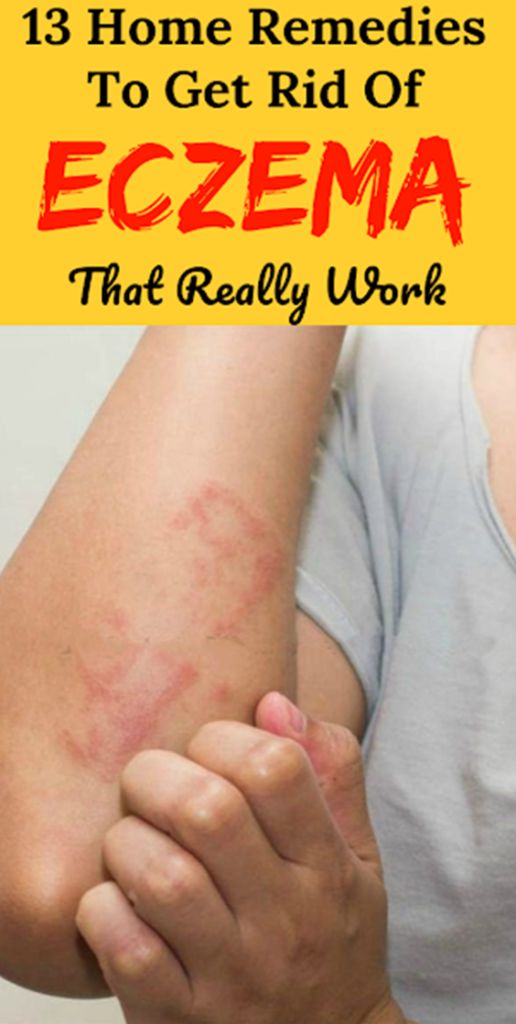 13 Home Remedies To Get Rid Of Eczema That Really Work â Gonnee ...