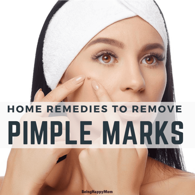 13 Home Remedies To Remove Pimple Marks Naturally for Oily Skin