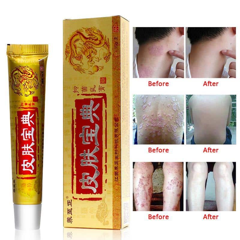 15g Natural Chinese Medicine Herbal Anti Bacteria Cream Psoriasis ...