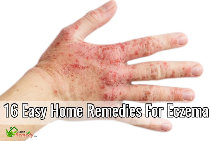 16 Easy Home Remedies for Eczema on Hands