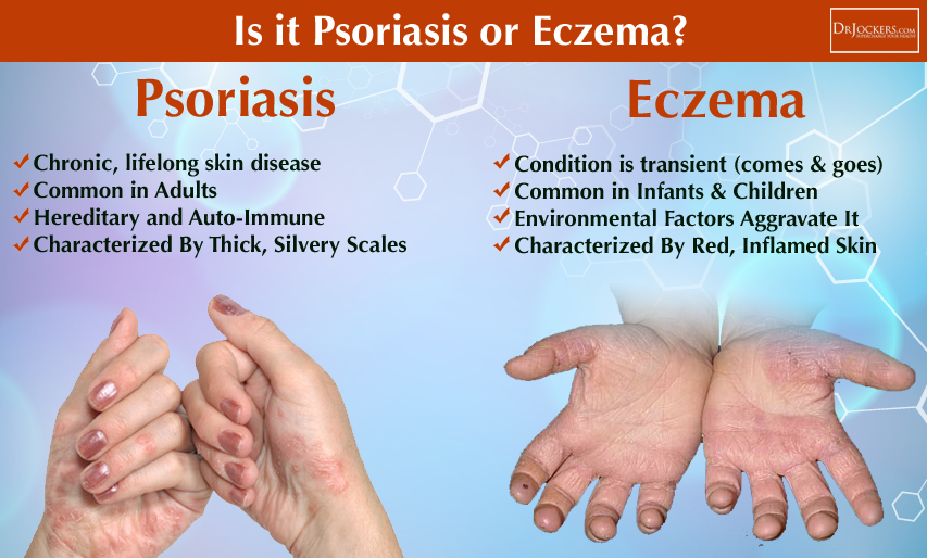 18 Ways to Beat Eczema, Acne and Psoriasis