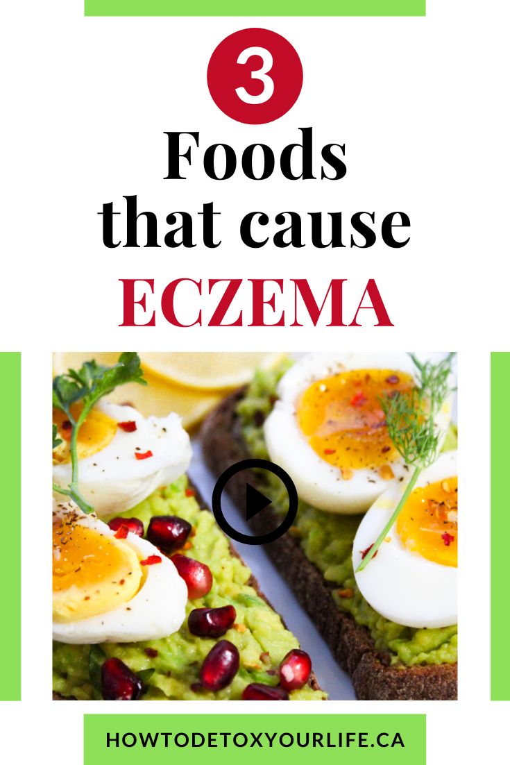 3 Eczema trigger foods in 2020