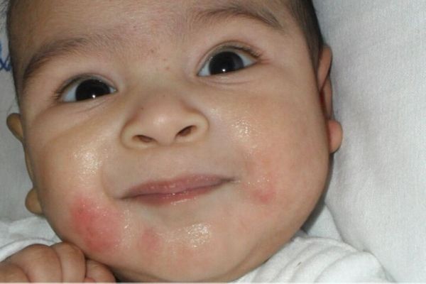 3 Things That I Did To Cure Eczema On (My) Baby ...