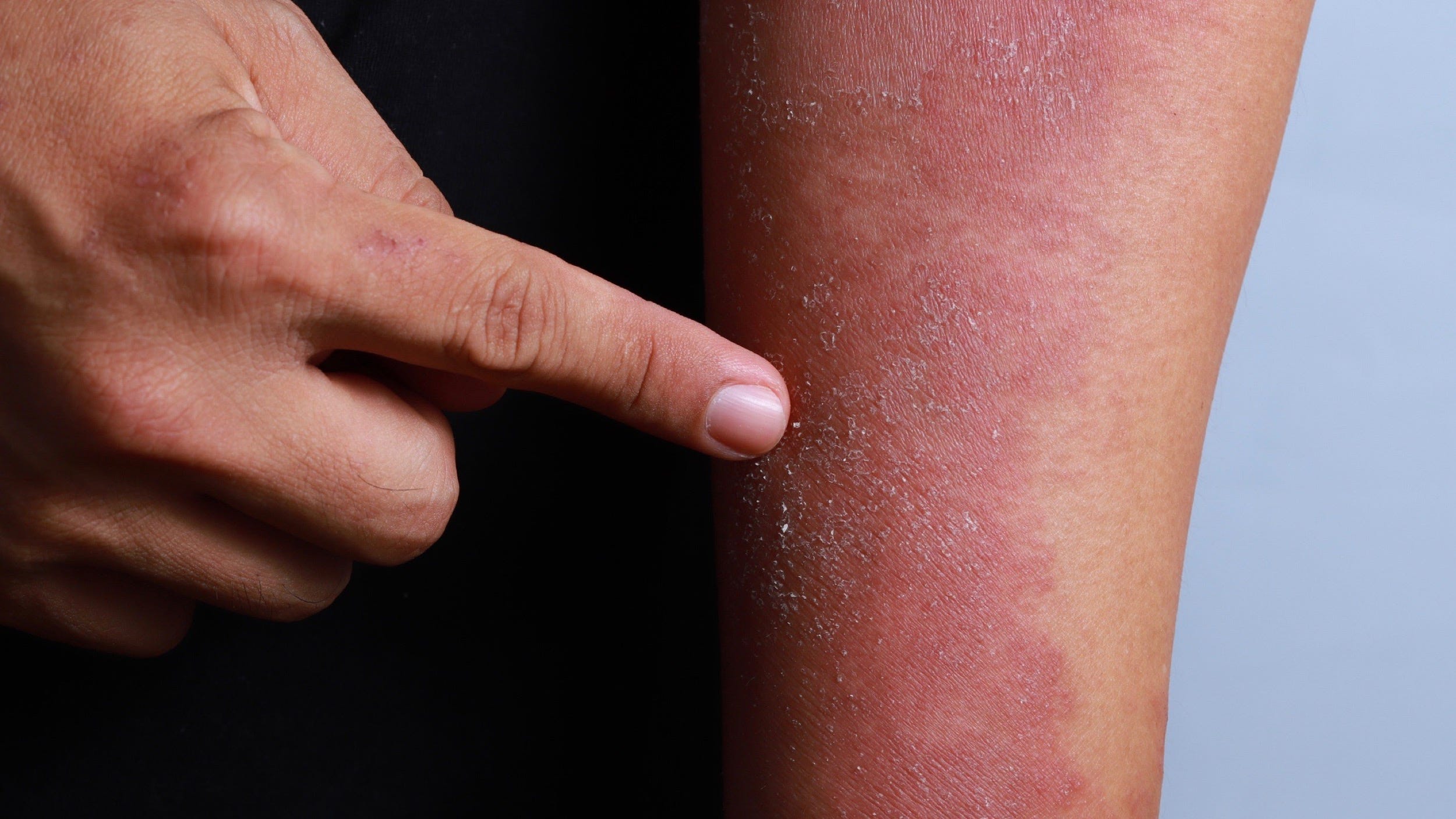 3 ways to get rid of eczema and prevent flare ups