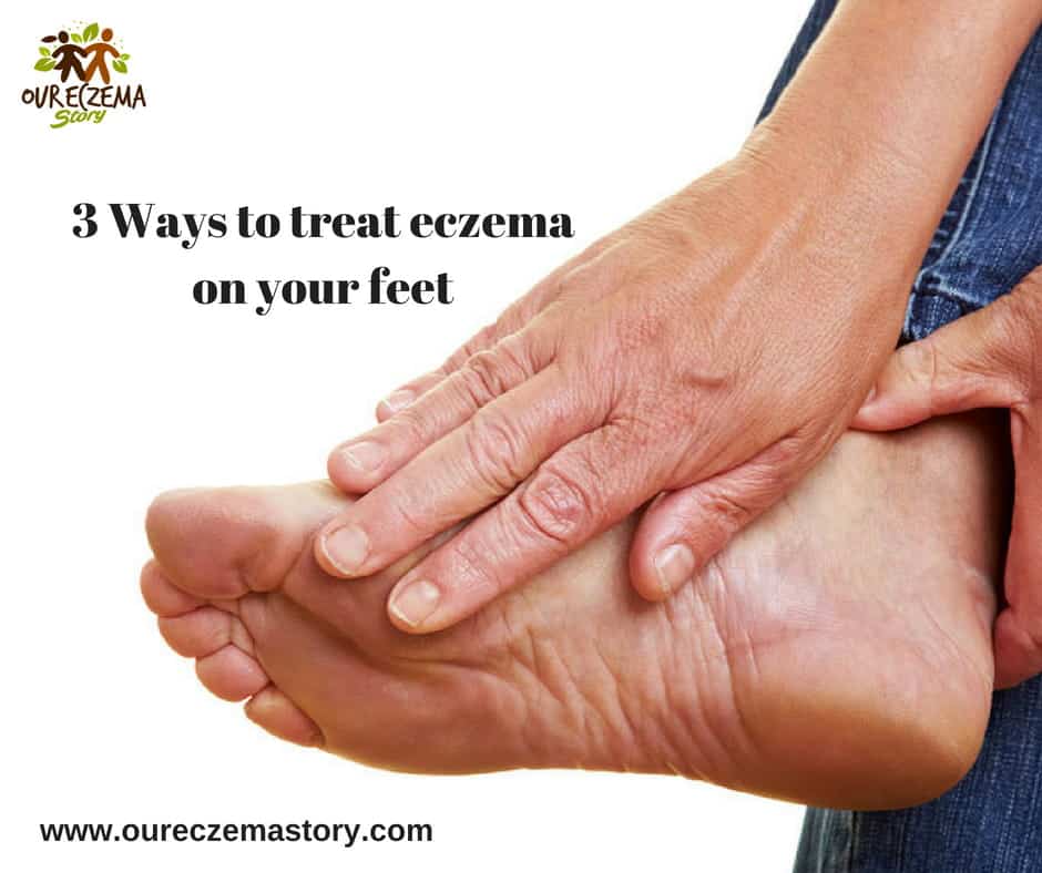 3 Ways To Treat Eczema On Your Feet