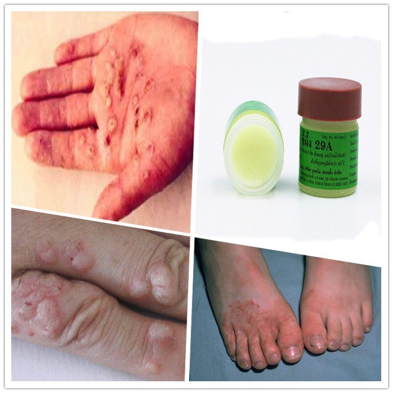 3PCS/Lot Thailand Professional psoriasis cure ointment eczema ...
