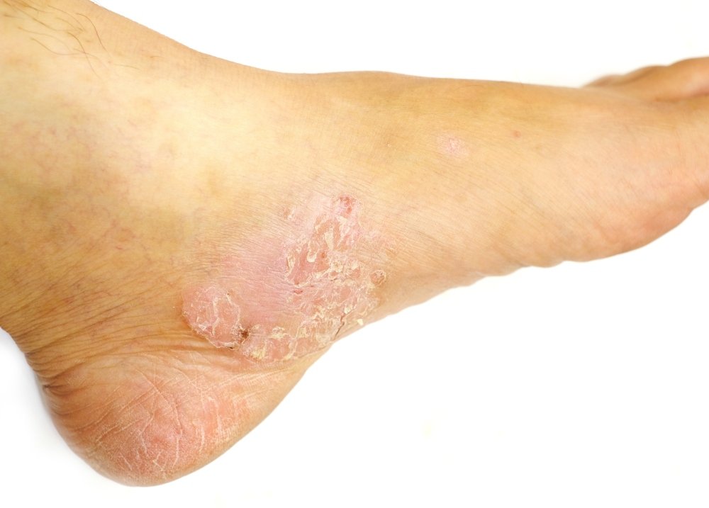 4 Common Foot Skin Problems &  Treatments
