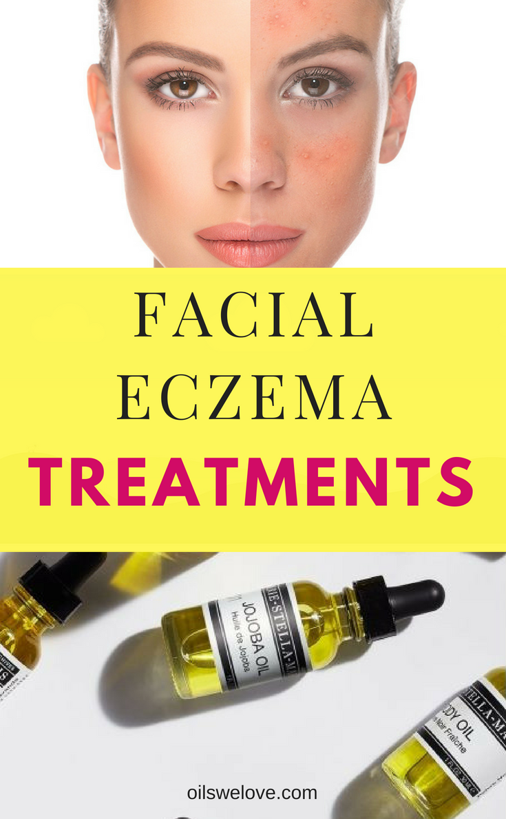 40 Natural Eczema Treatments &  Remedies