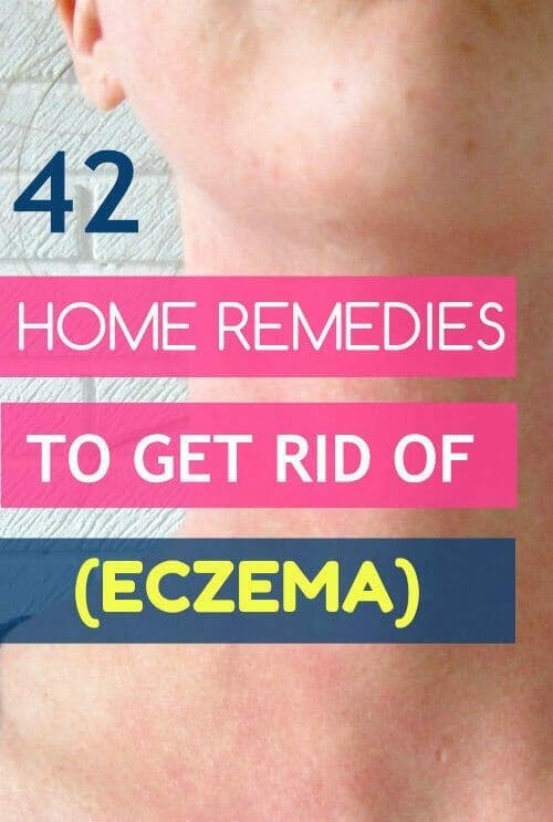 42 Proven Home Remedies to Get Rid of Eczema