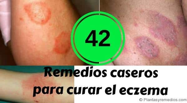 42 remedios caseros para curar el eczema