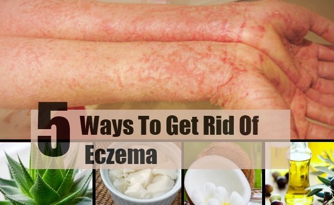 5 Best And Effective Ways To Get Rid Of Eczema