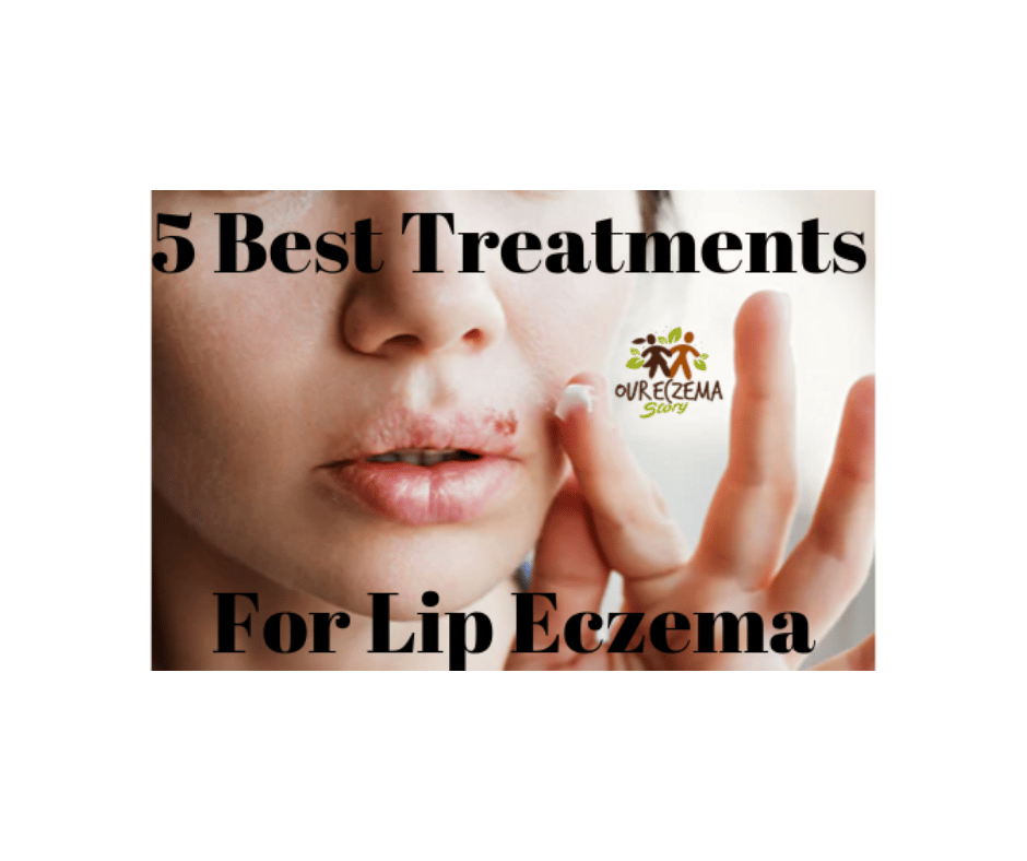 5 Best Treatments For Lip Eczema