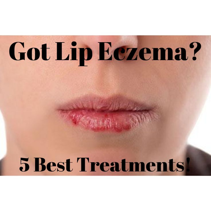 5 Best Treatments For Lip Eczema