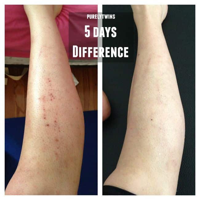5 days difference with new diet to heal eczema
