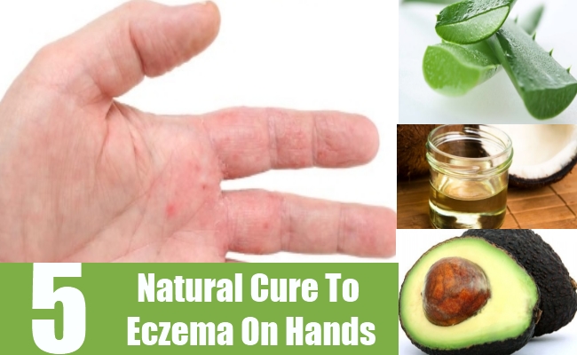 5 Easy And Simple Ways To Cure Eczema On Hands Naturally