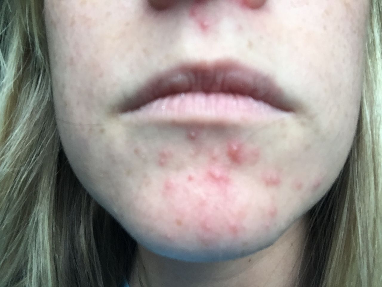 5 Easy Tips That Helped My Perioral Dermatitis Clear Up ...