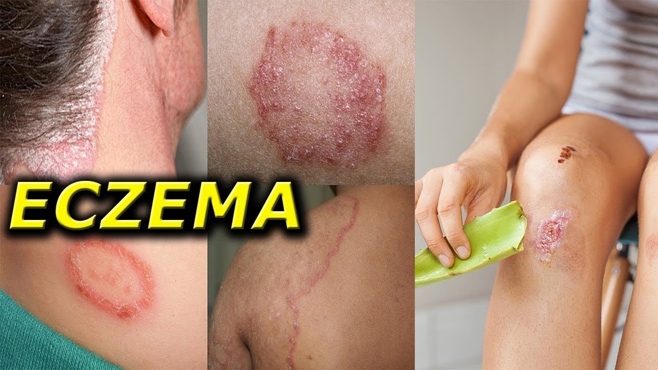 5 Home Remedies for Eczema