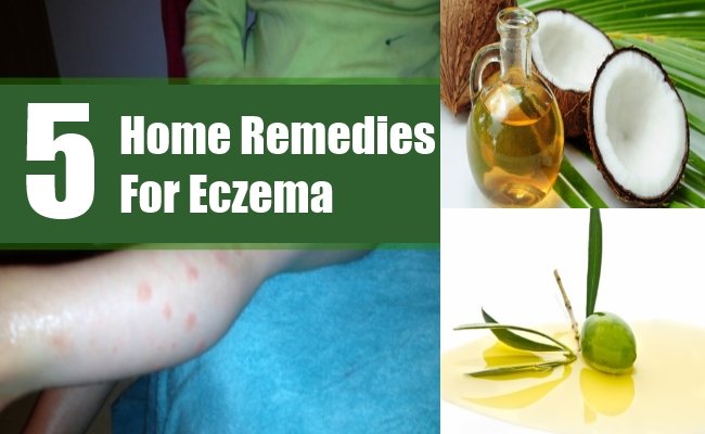 5 Home Remedies For Eczema