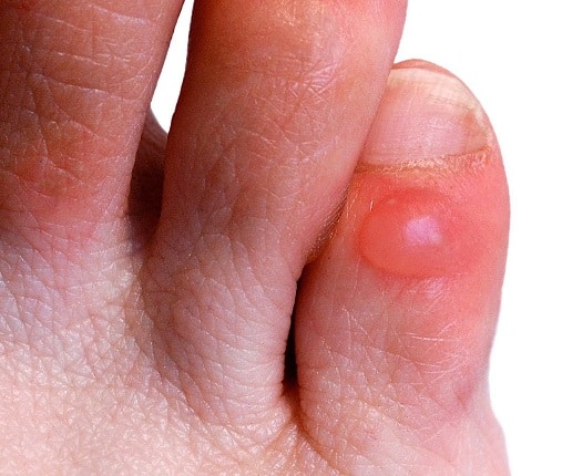 5 Major Foot Bumps and How to Deal with Them