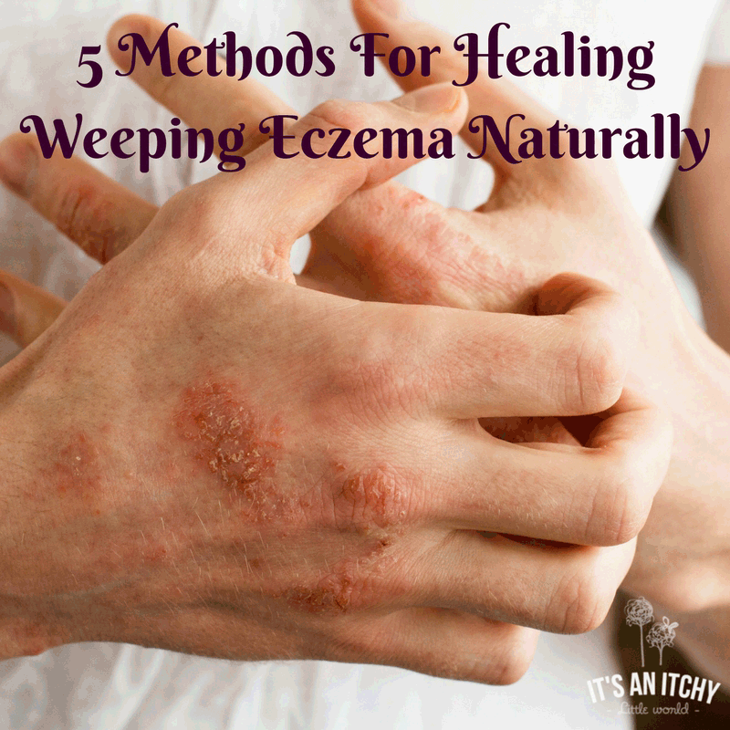 5 Methods For Healing Weeping Eczema Naturally