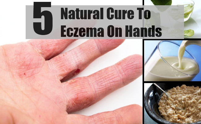 5 Natural Cure For Eczema On Hands