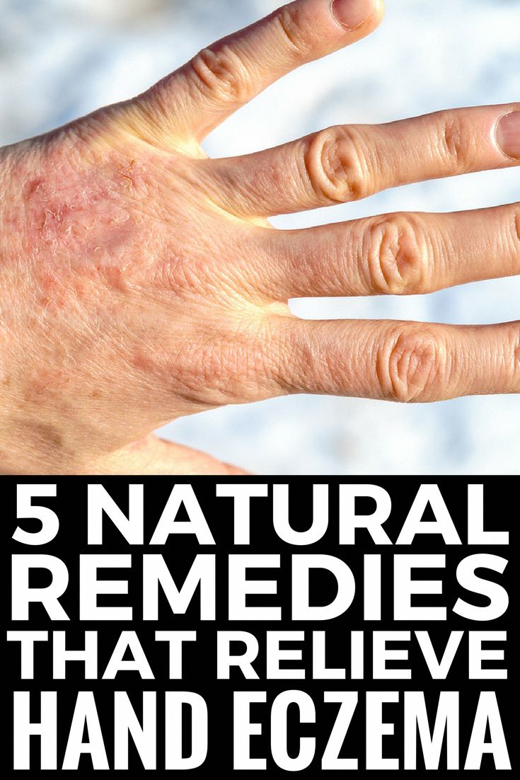 5 Natural Hand Eczema Remedies that Work! There are different types of ...