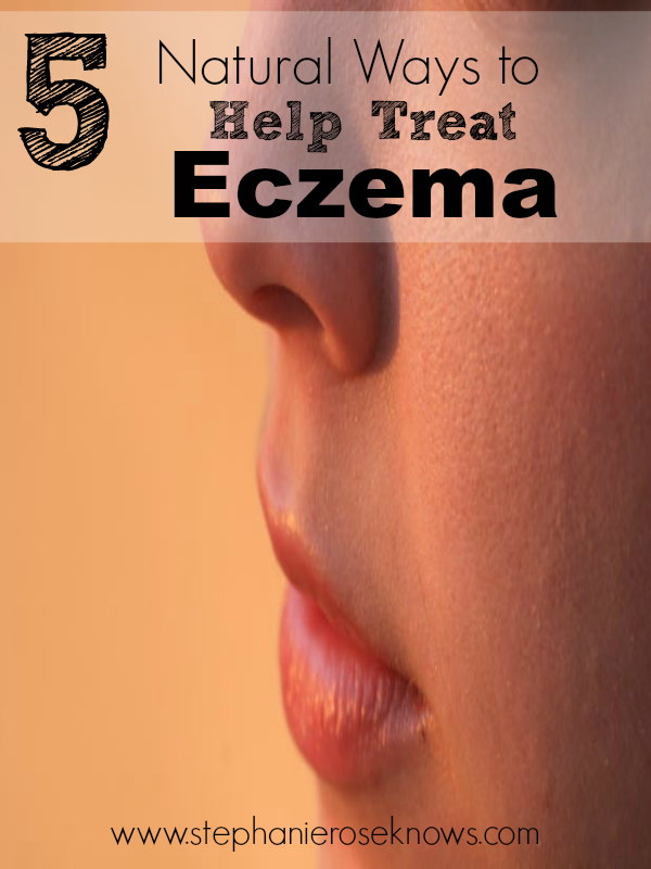 5 Natural Ways to Help Treat Eczema