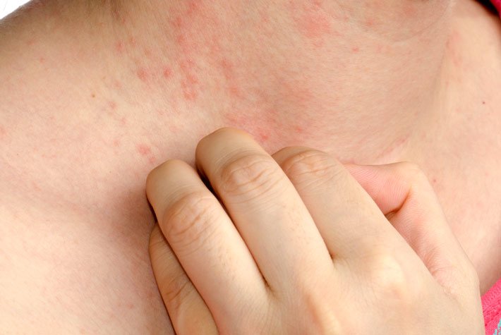 5 Symptoms Of Eczema That People Might Be Ignoring