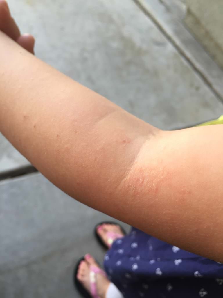 5 Tips For Treating Toddler Eczema