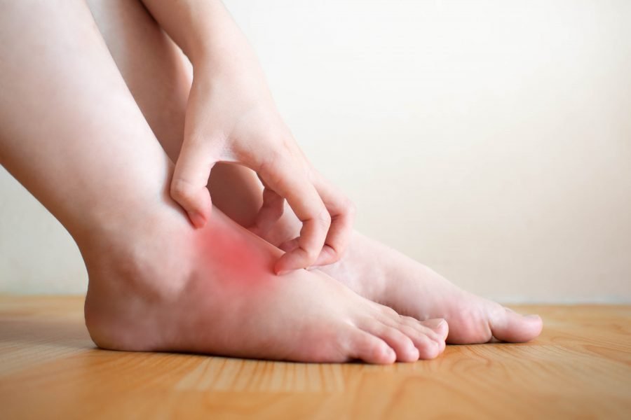 5 tips to relieve foot eczema