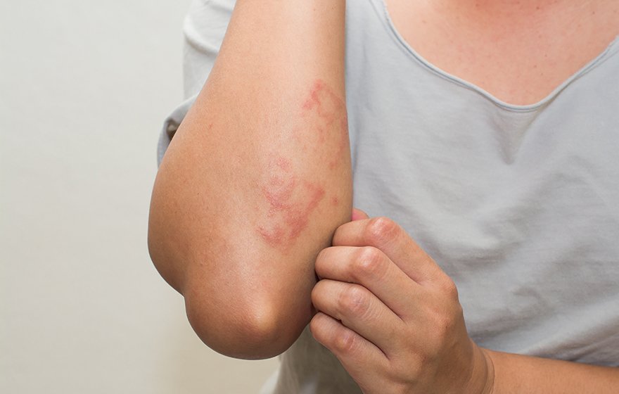 5 Types of Eczema Commonly Found in Older Adults, Plus ...