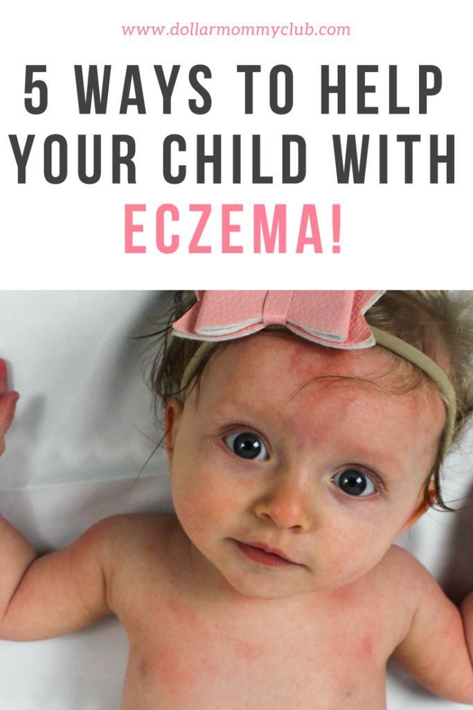 5 Ways To Help Your Child With Eczema.