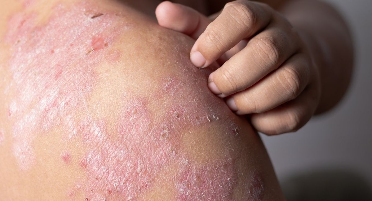 5 Ways to Settle your Eczema Flare