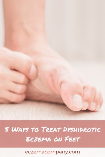 5 Ways to Treat Dyshidrotic Eczema on Feet