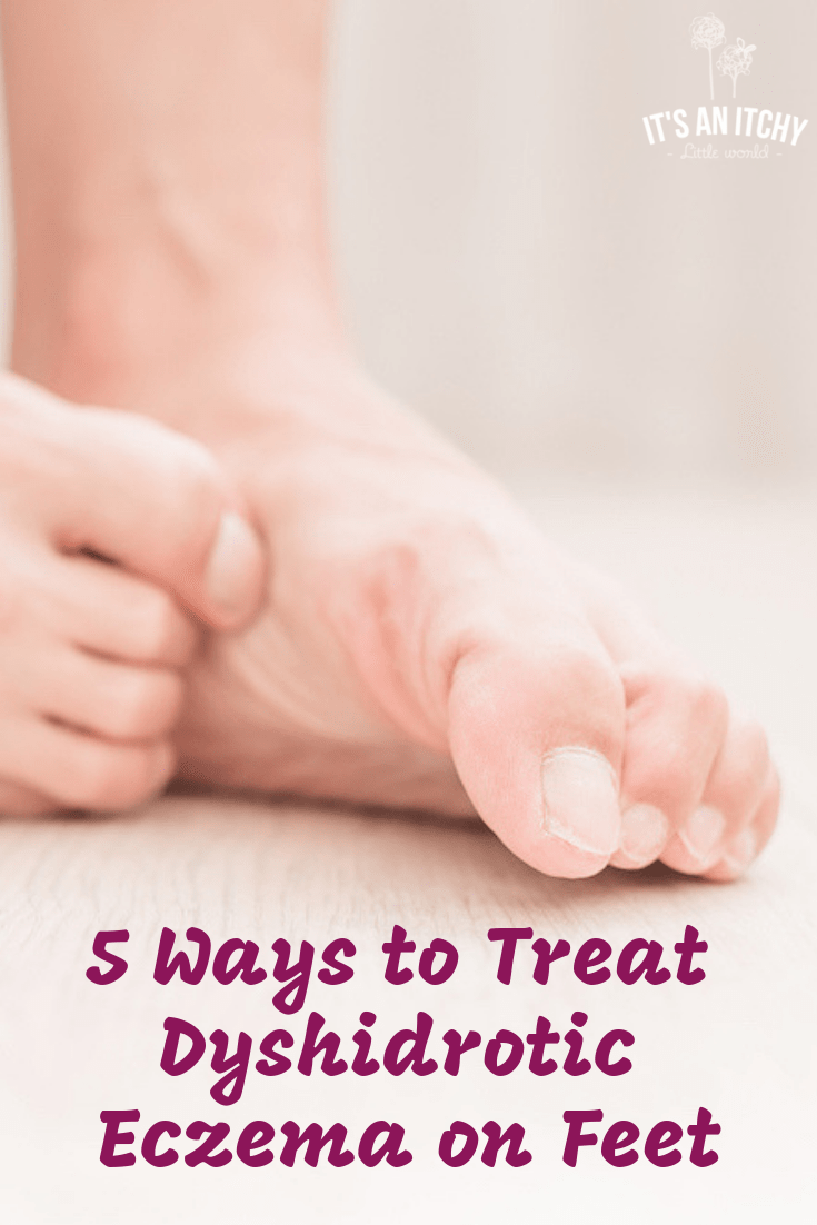 5 Ways to Treat Dyshidrotic Eczema on Feet