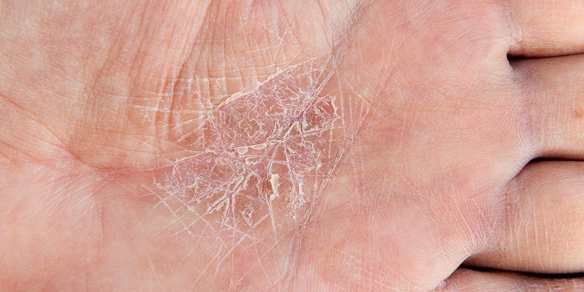 6 Eczema Symptoms You Should Bring Up With Your Derm