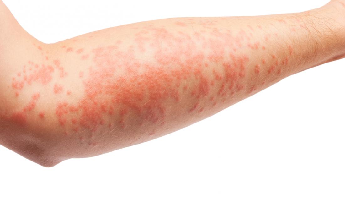 6 Home Remedies To Get Rid Of Eczema