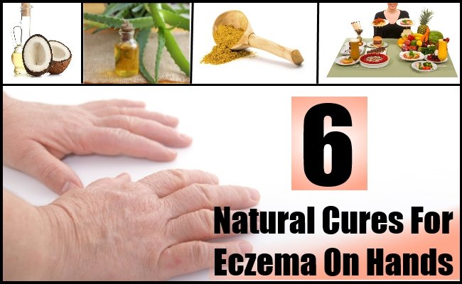 6 Natural Cures For Eczema On Hands  Natural Home ...